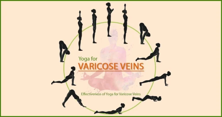 Does yoga improve varicose veins: