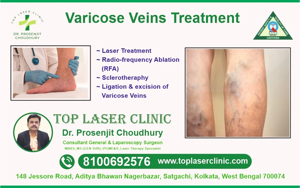 Basic Information about Varicose Vein