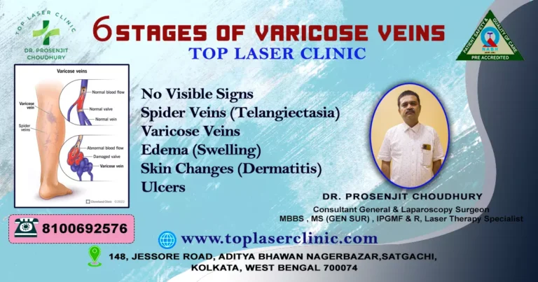 6 stages of varicose veins