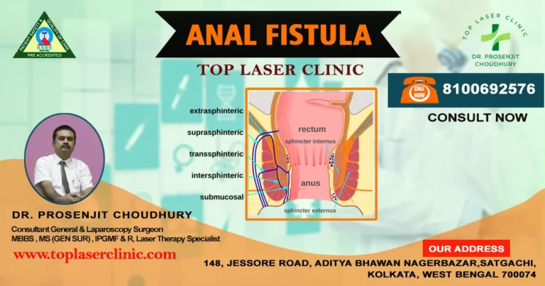 Anal Fistula