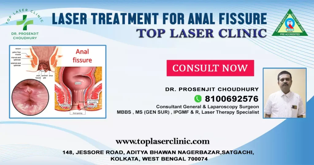 Laser treatment for anal fissure
