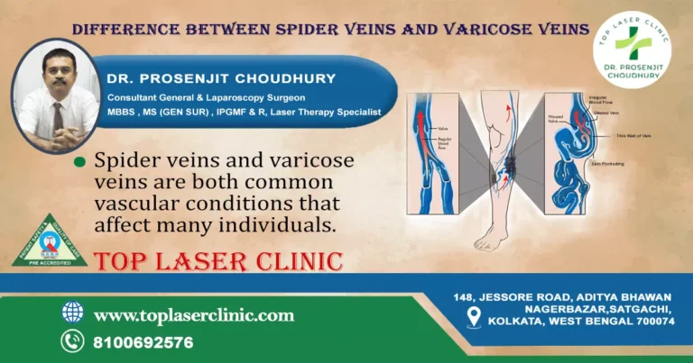 Difference between spider veins and varicose veins