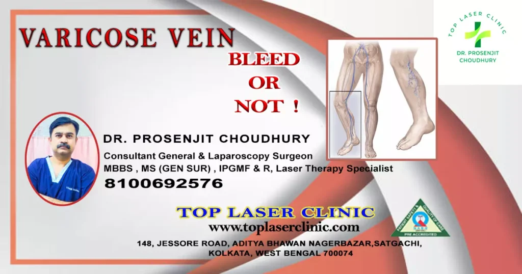 whether varicose vein bleed or not