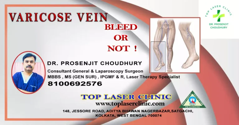 whether varicose vein bleed or not