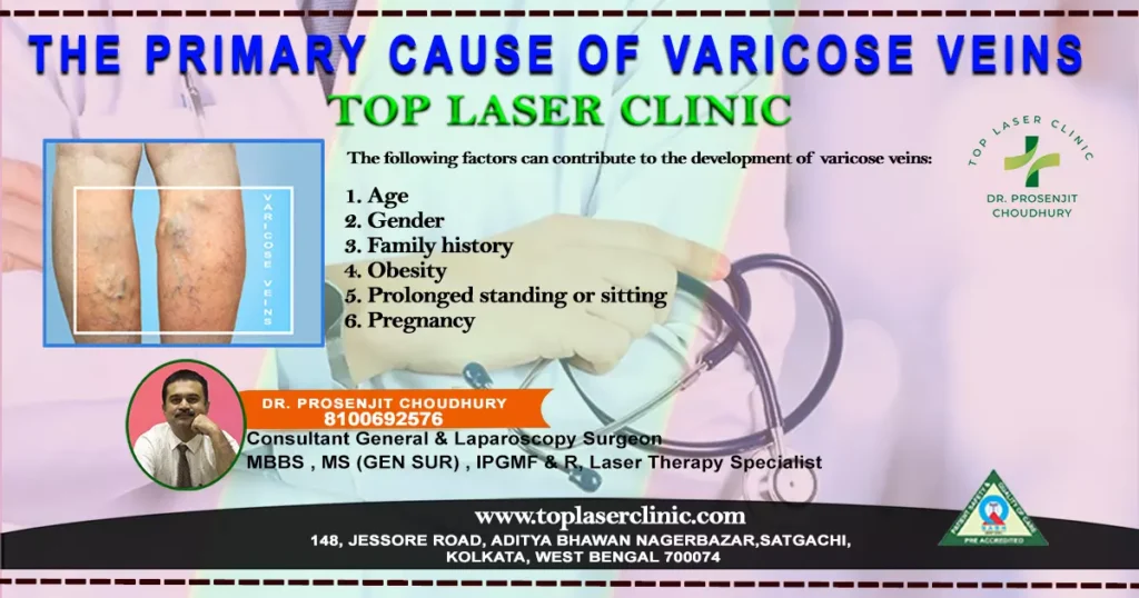 Primary-Cause-of-Varicose-Veins-factors- contribute-varicose-veins