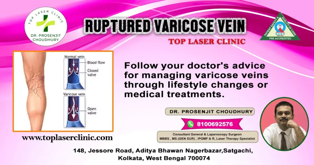 Ruptured-varicose-vein-follow-your-doctor's-advice