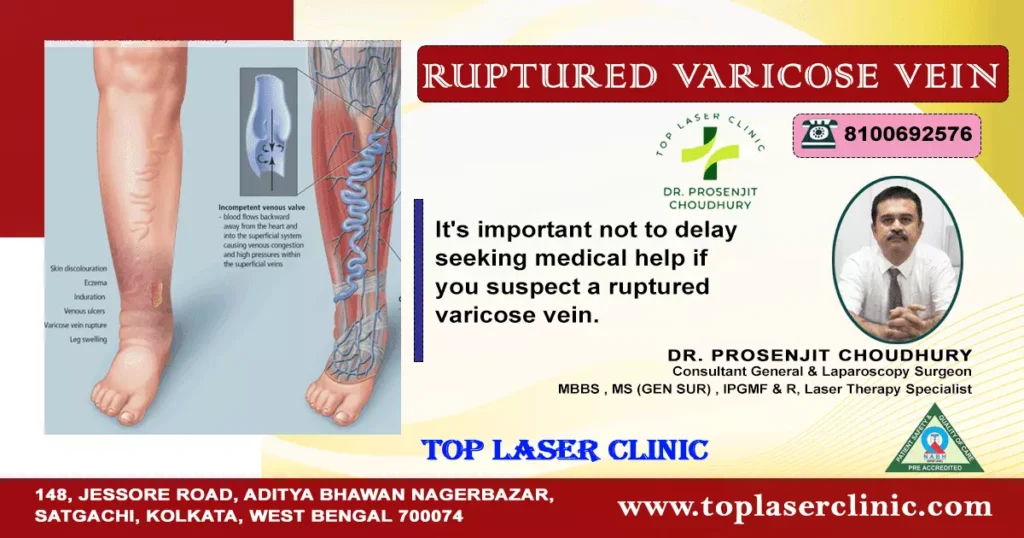 Ruptured-varicose-vein-it-is-important-to-not-to-delay