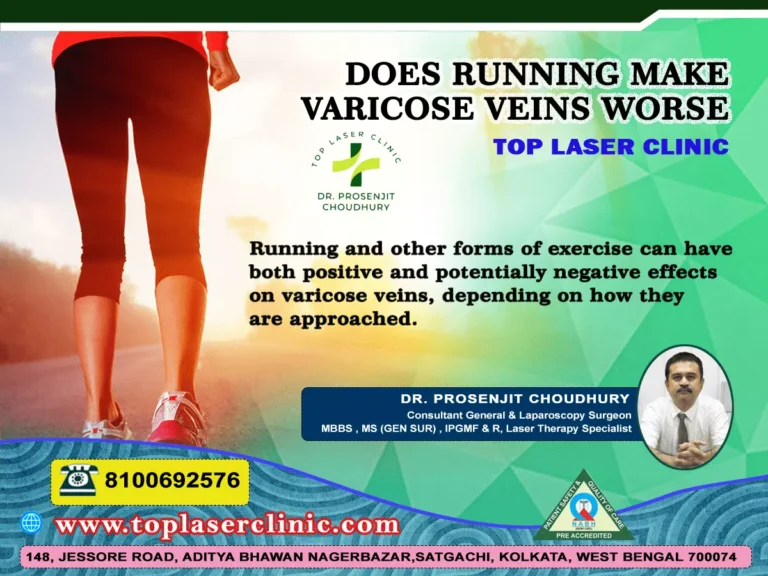 Does running make varicose veins worse?