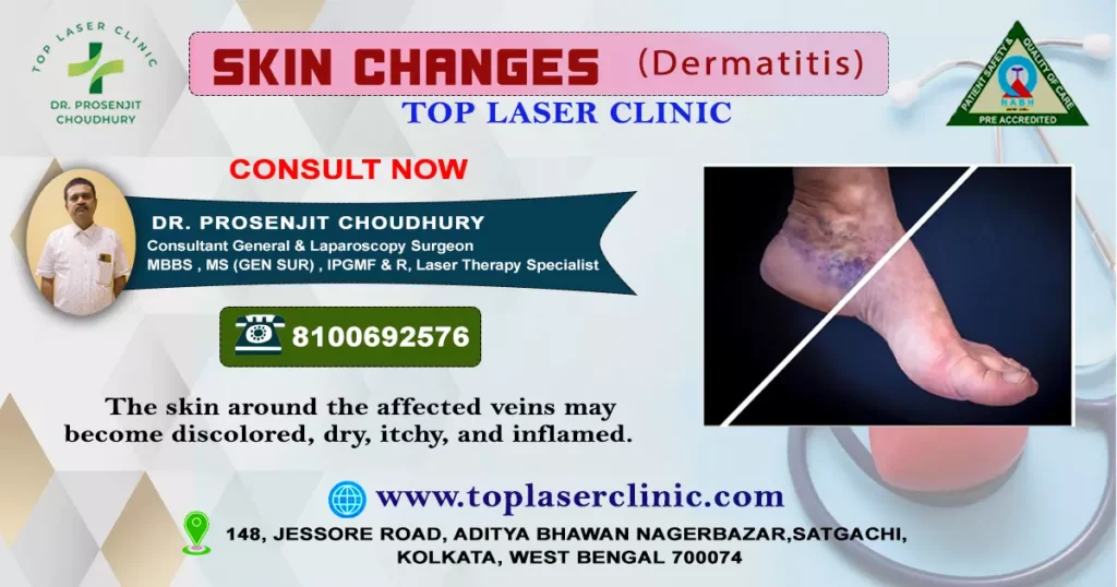 stages-of-varicose-veins-skin-changes-dermatitis