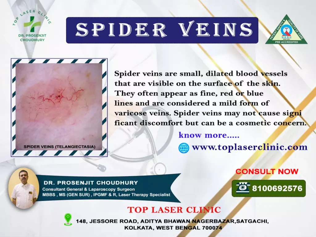 stages-of-varicose-veins-spider-veins