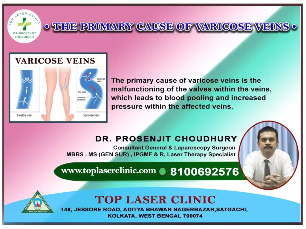 Primary-Cause-of-Varicose-Veins-the- primary-cause-is-the-malfunctioning-of- valves
