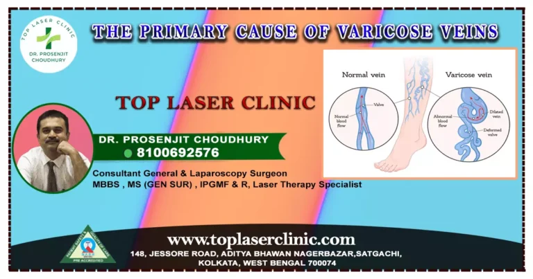 6 Primary Cause of Varicose Veins