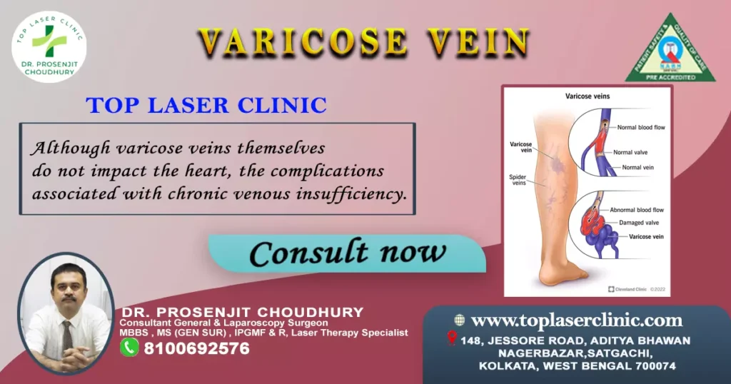 whether varicose vein affect heart