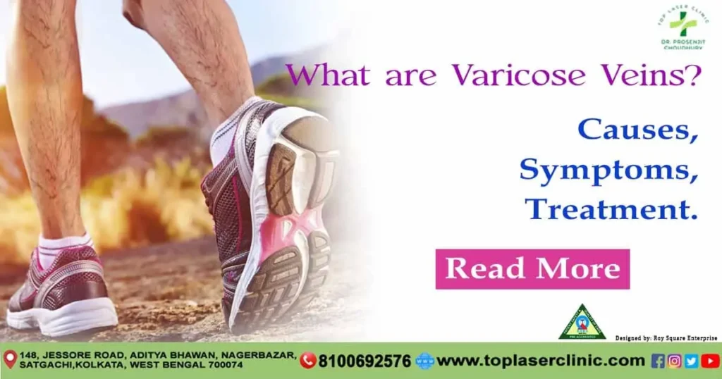 what-are-varicose-veins