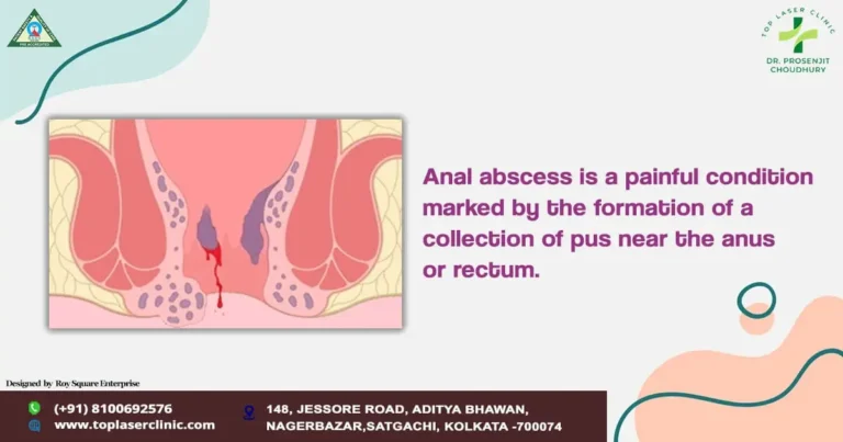 Relief Beyond the Pain: Navigating Anal Abscess with Care and Expertise