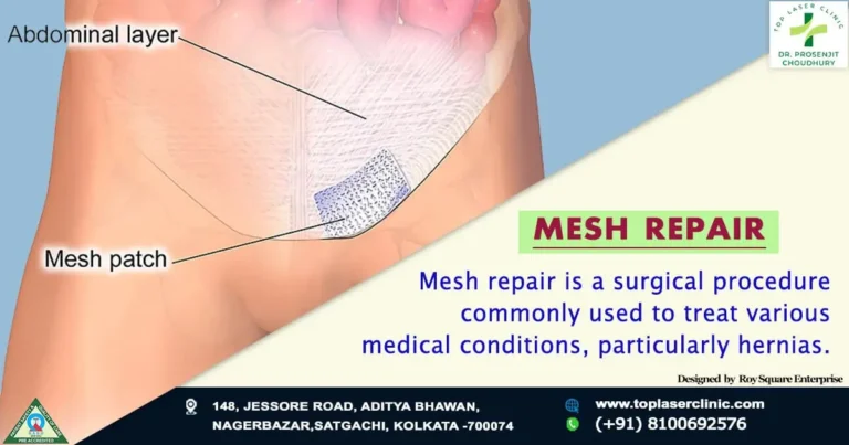 Seamlessly restoring strength and support: Mesh Repair Solutions