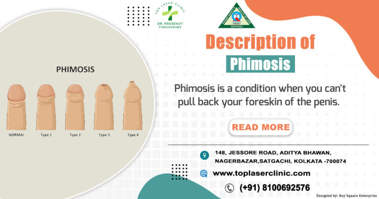 Understanding Phimosis: Description, Symptoms, Types, Causes & Treatment