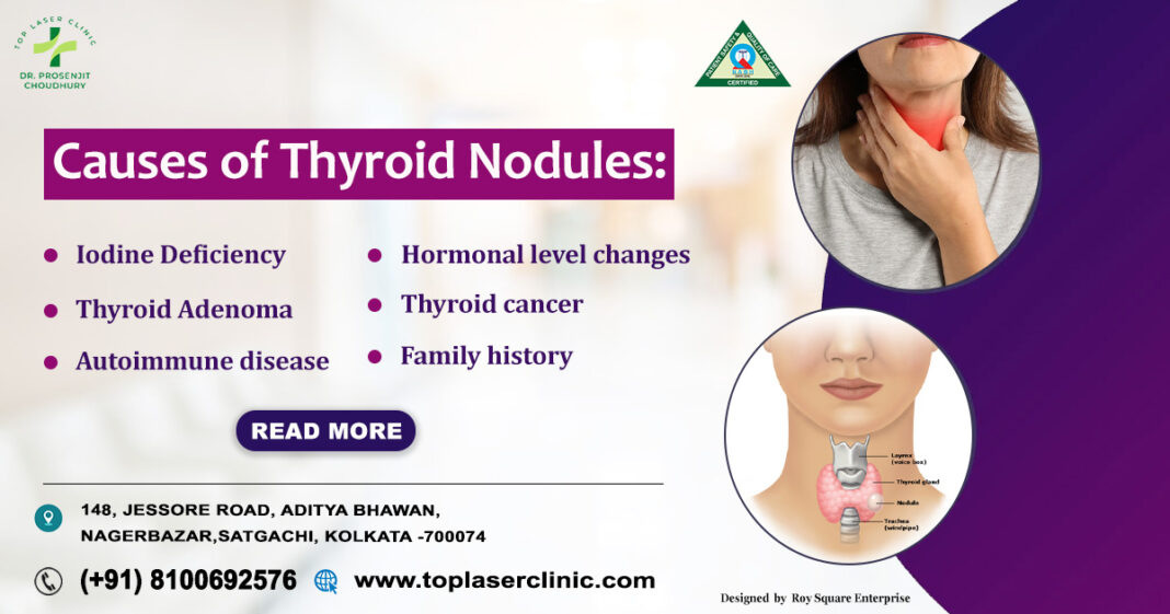Thyroid Nodules Causes Signs Expert Treatment Options Photo Inspiration