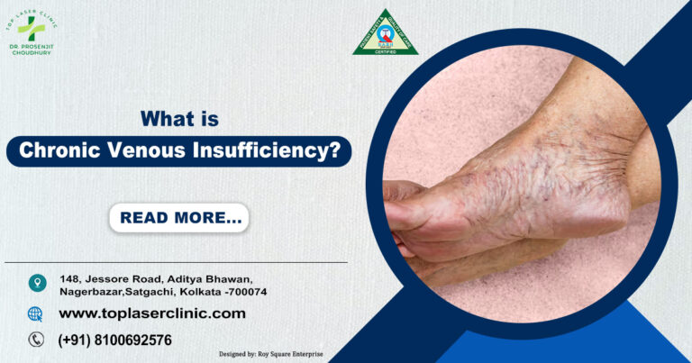 Chronic Venous Insufficiency: Causes, Symptoms, Stages, Treatment