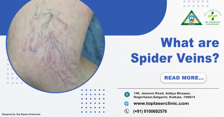 Spider Veins: Causes, Symptoms & Treatment Options