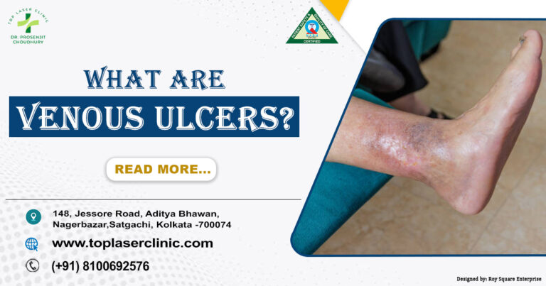 Venous Ulcers: Causes, Symptoms & Treatments