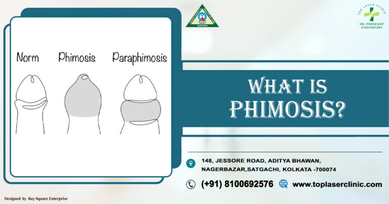 Phimosis: Breakthrough Guide to Understanding top 7 Symptoms, Types, Causes & Treatment Options