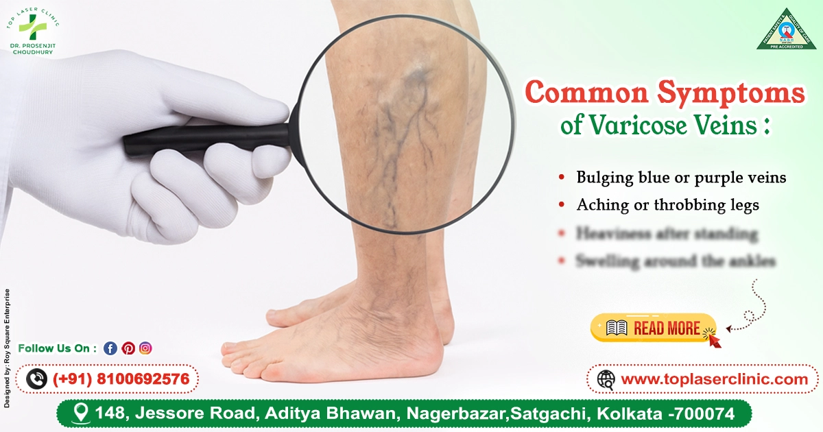 Common Symptoms of Varicose Veins