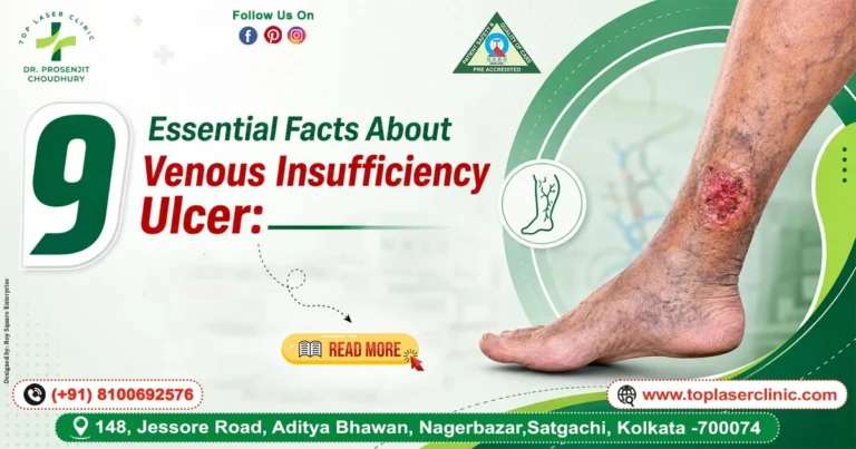 9 Essential Facts About Venous Insufficiency Ulcer: The Complete Guide to Causes, Symptoms, Treatment & Prevention